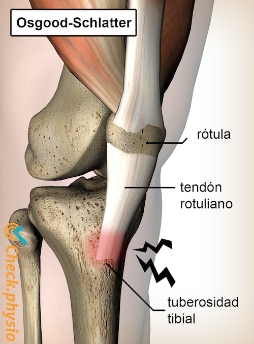 rodilla osgood schlatter dolor tendón rotuliano