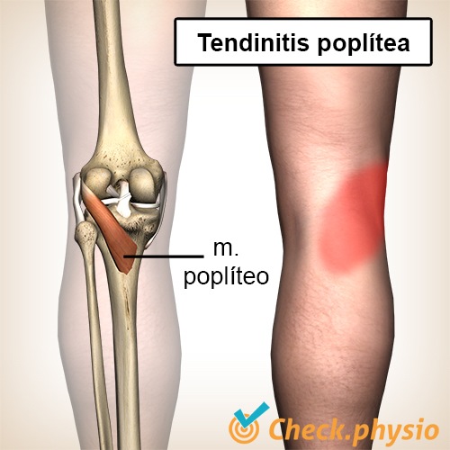 rodilla tendinitis del poplíteo