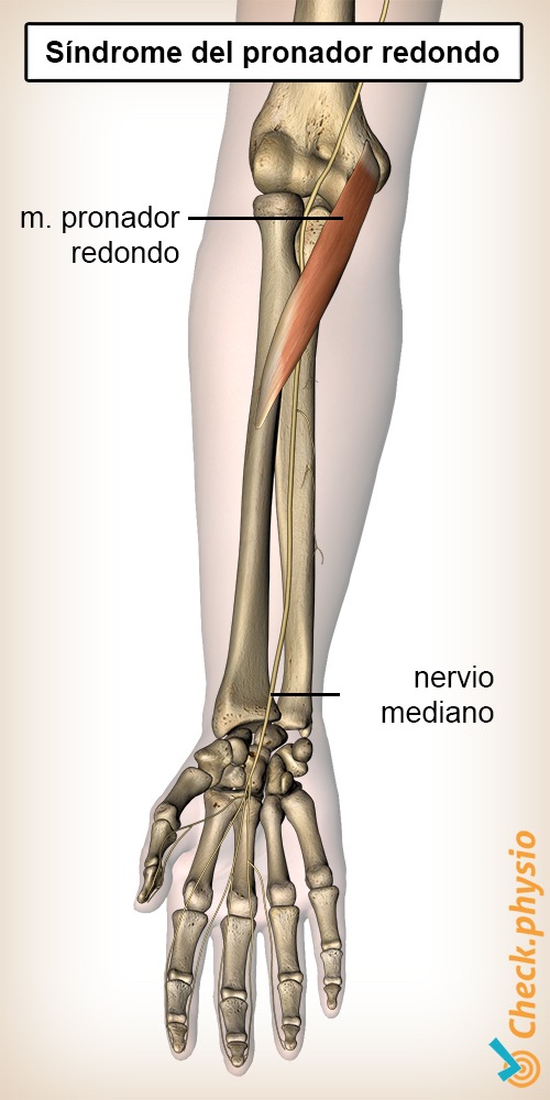 antebrazo síndrome del pronador redondo músculo nervio mediano