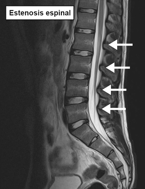 espalda columna lumbar resonancia magnética estenosis del canal espinal