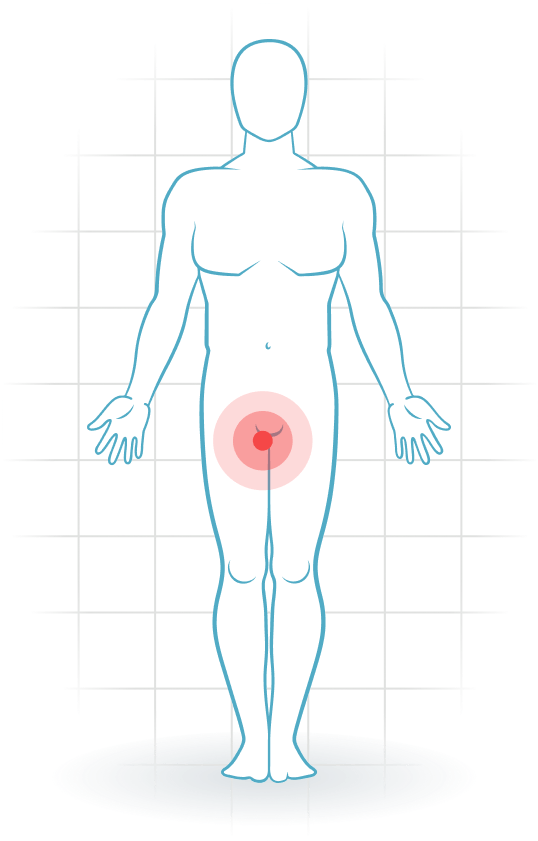 pijnlocatie Dolor inguinal relacionado con los aductores